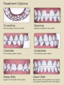 type of bites that indicate needing braces.
