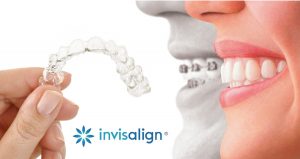 Invisalign invisible orthodontic aligners